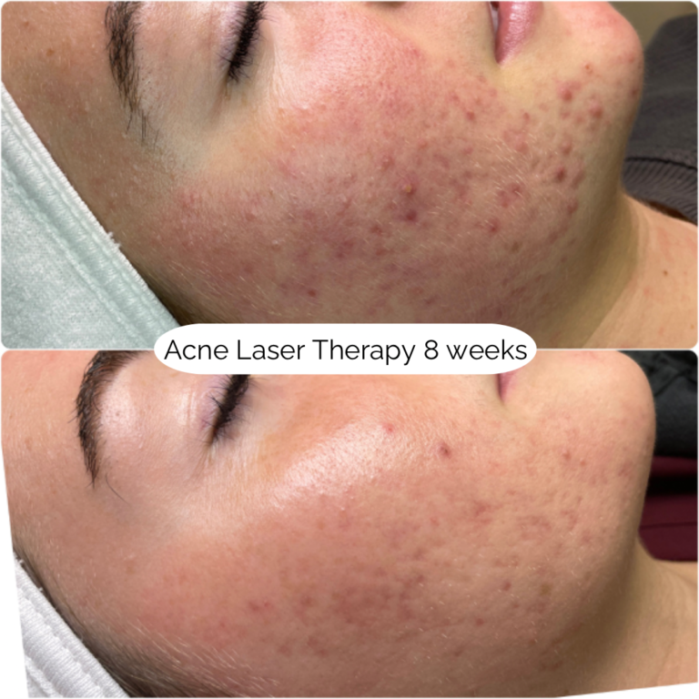 Acne Laser Therapy 8week