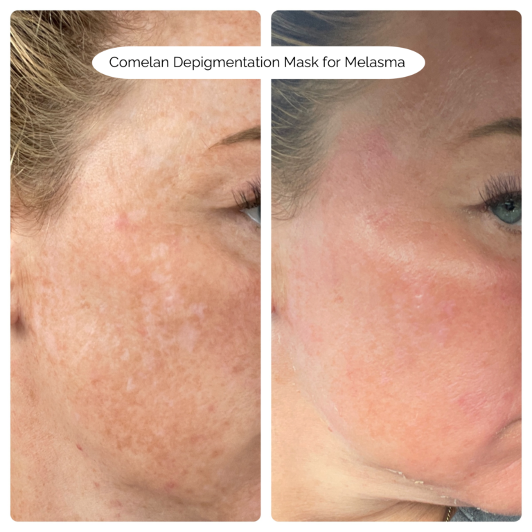 Comelan Depigmentation Mask for Melasma