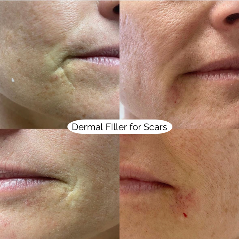 Dermal FIller for Scars