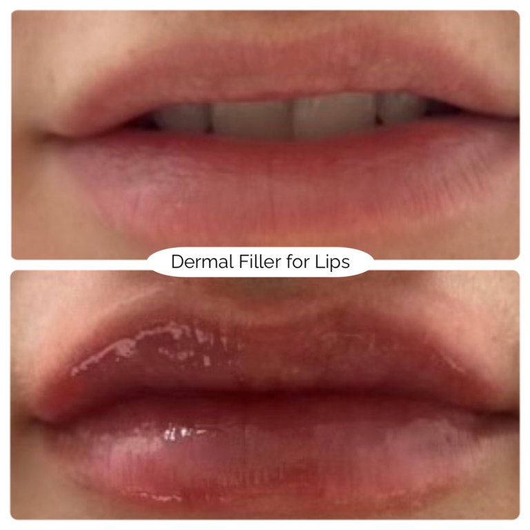 Dermal Filler for Lips 2