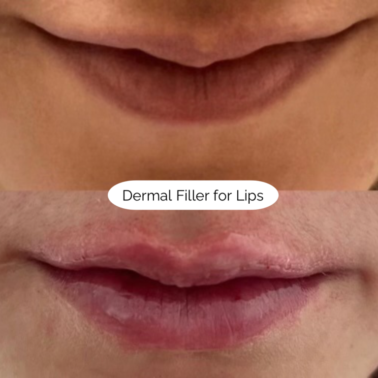 Dermal Filler for Lips