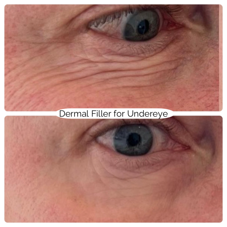 Dermal Filler for Undereye