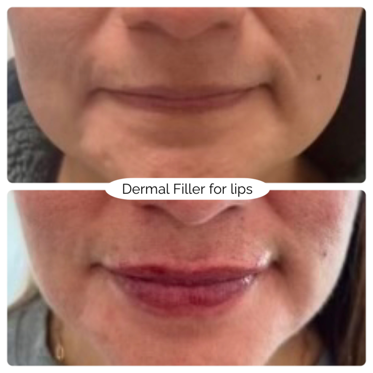 Dermal Filler for lips 3