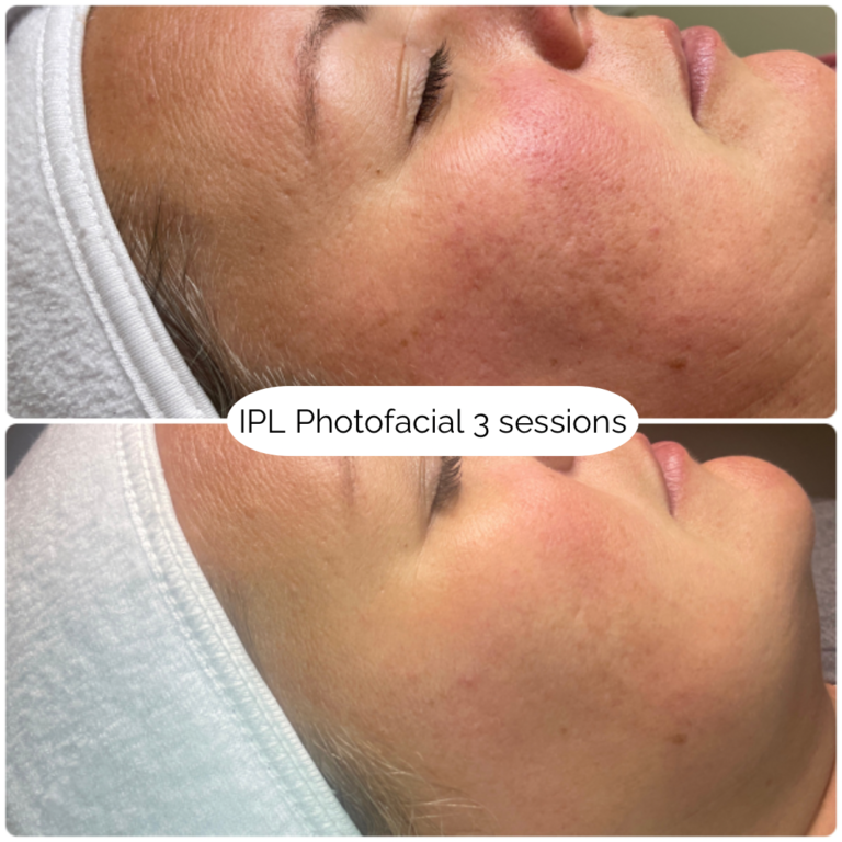 IPL Photofacial 3 sessions