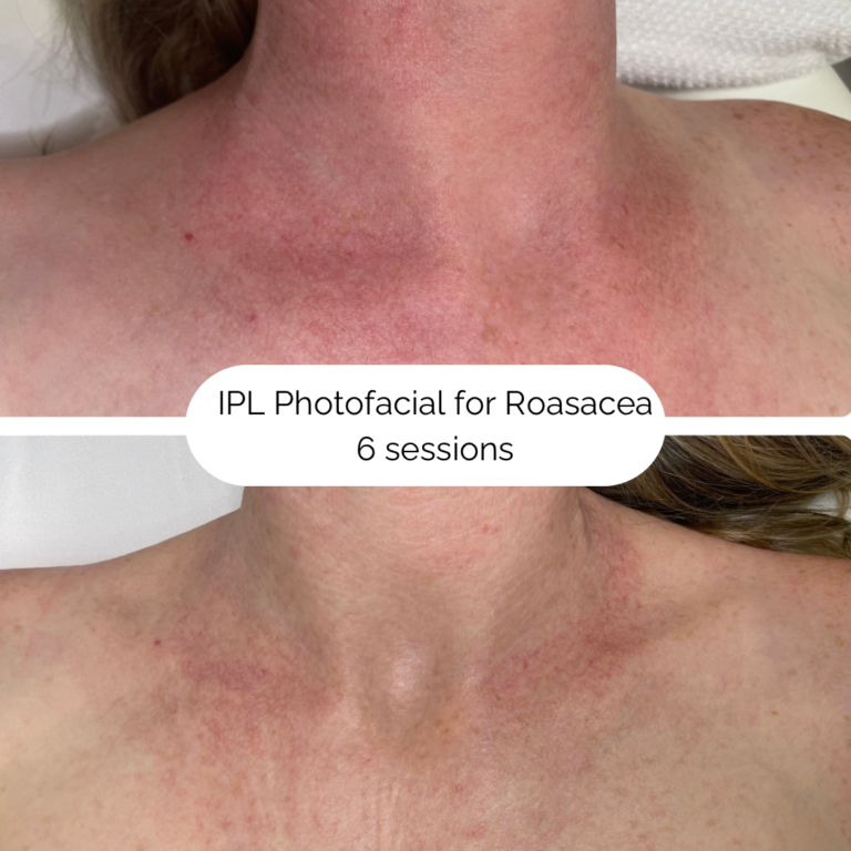 IPL Photofacial for Roasacea 6 sessions