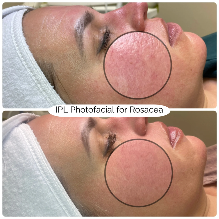 IPL Photofacial for Rosacea 2