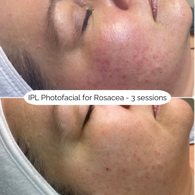 IPL Photofacial for Rosacea - 3 sessions 2