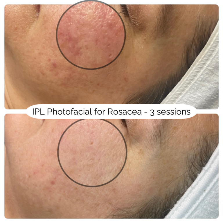 IPL Photofacial for Rosacea - 3 sessions