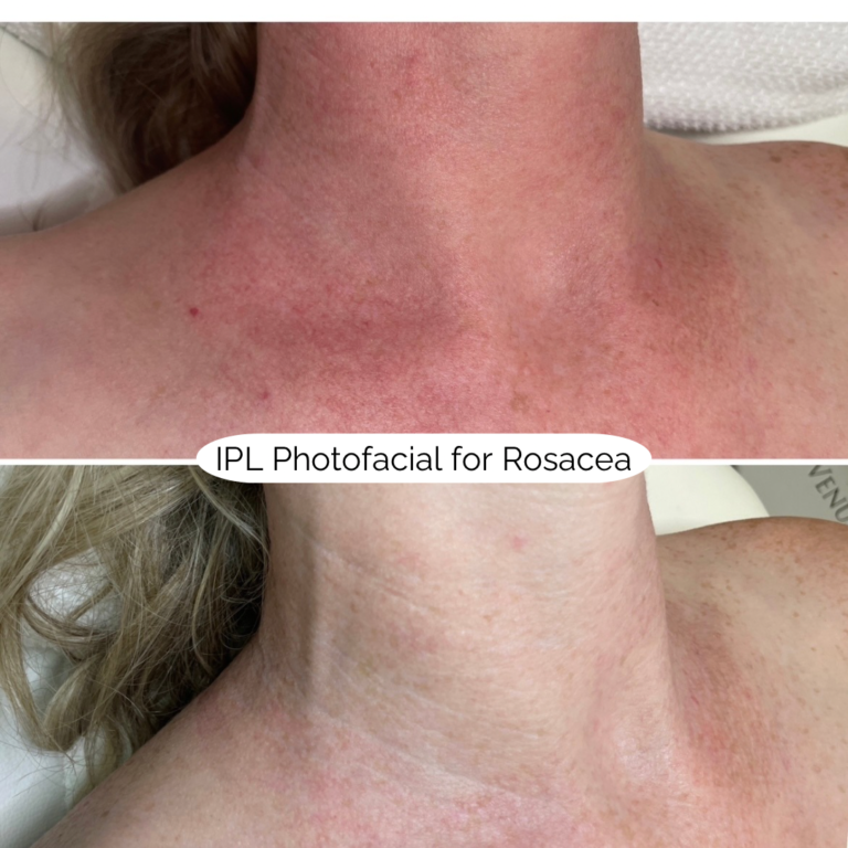 IPL Photofacial for Rosacea