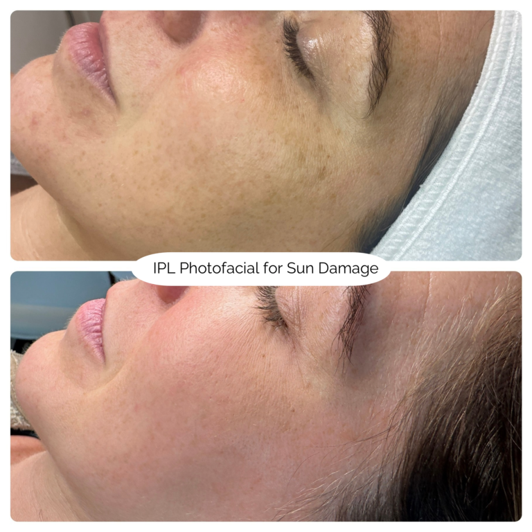 IPL Photofacial for Sun Damage 2