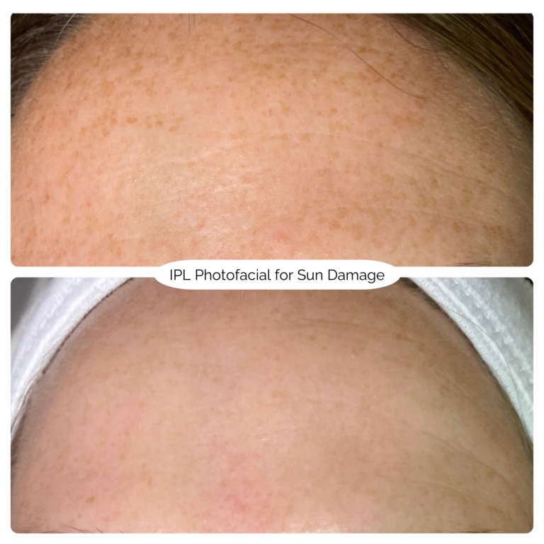 IPL Photofacial for Sun Damage 3