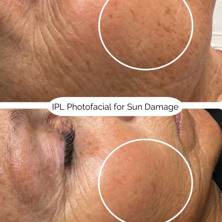 IPL Photofacial for Sun Damage 4