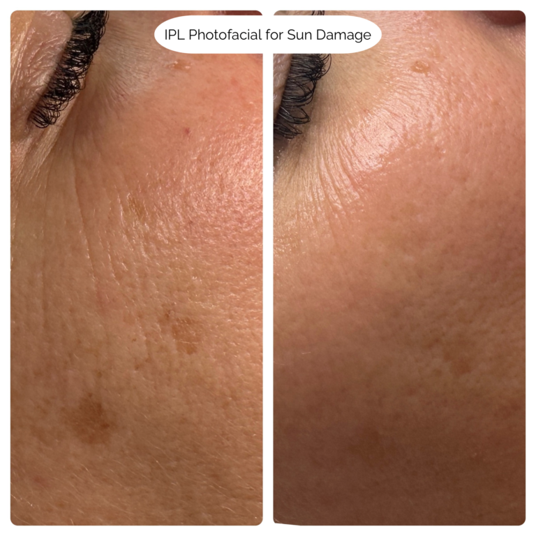 IPL Photofacial for Sun Damage 5