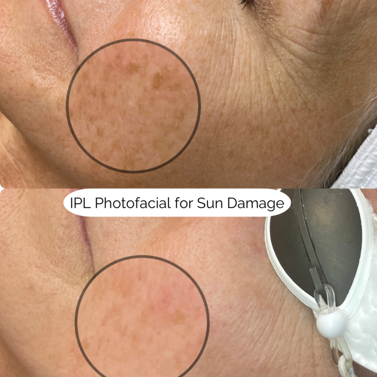 IPL Photofacial for Sun Damage 6