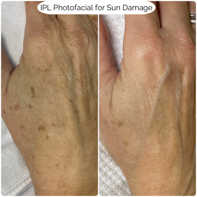 IPL Photofacial for Sun Damage 7