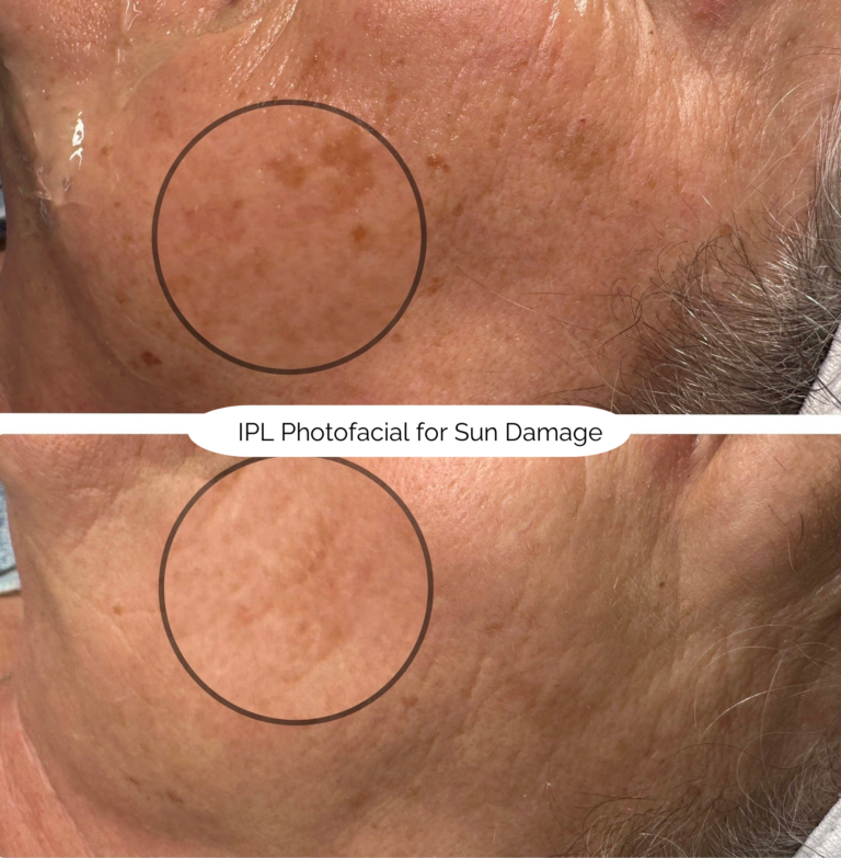 IPL Photofacial for Sun Damage