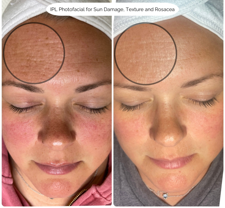 IPL Photofacial for Sun Damage, Texture and Rosacea