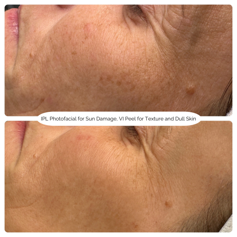 IPL Photofacial for Sun Damage, VI Peel for Texture and Dull Skin