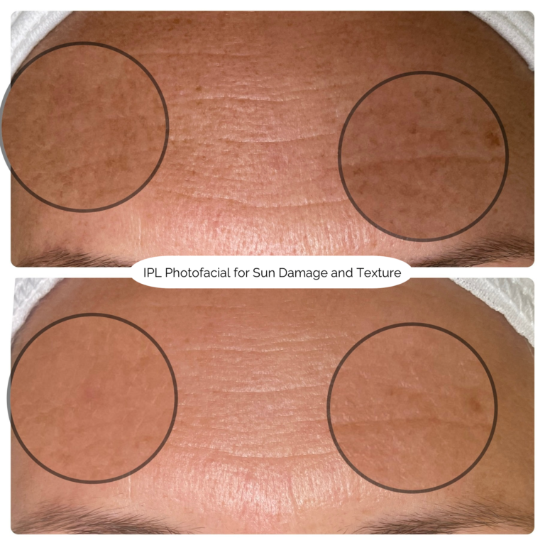 IPL Photofacial for Sun Damage and Texture