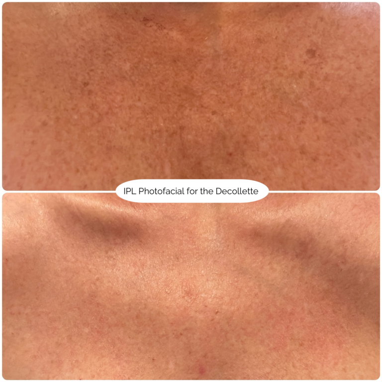 IPL Photofacial for the Decollette