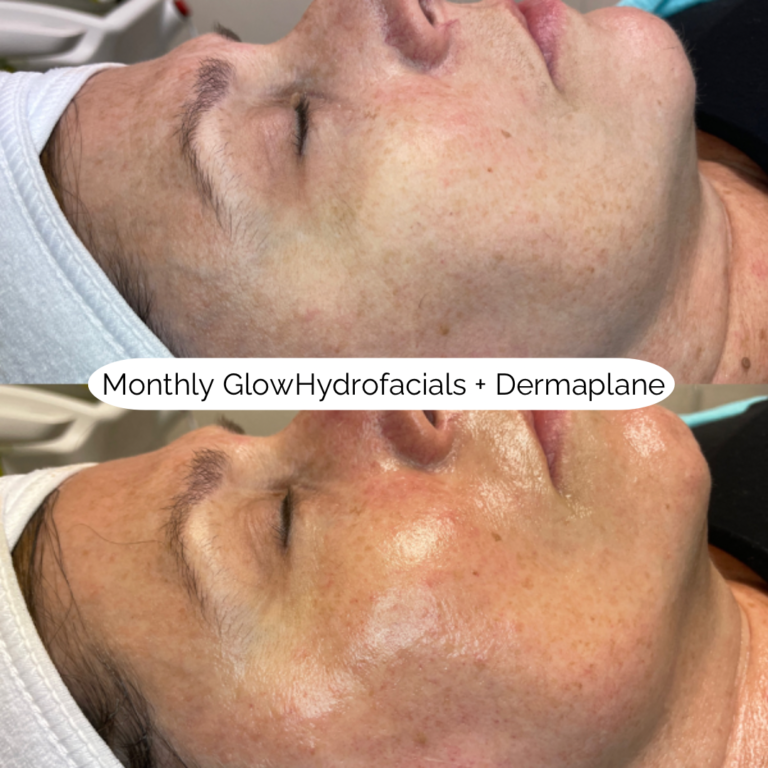 Monthly Dermaplanes + Dermaplane