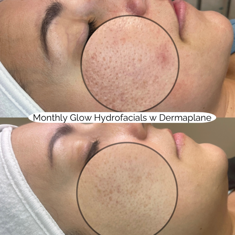 Monthly Glow Hydrofacials w Dermaplane