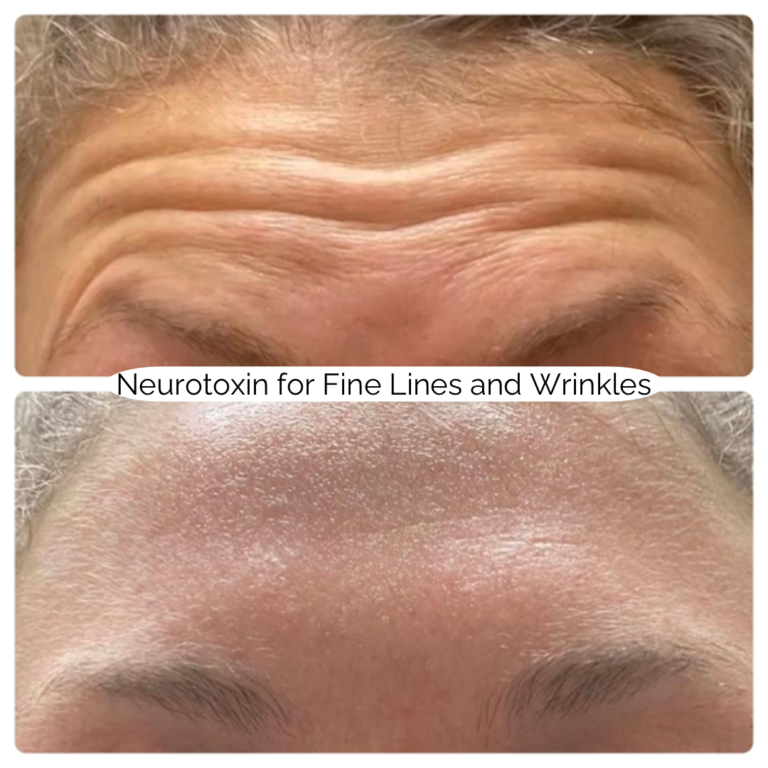 Neurotoxin for Fine Lines and Wrinkles