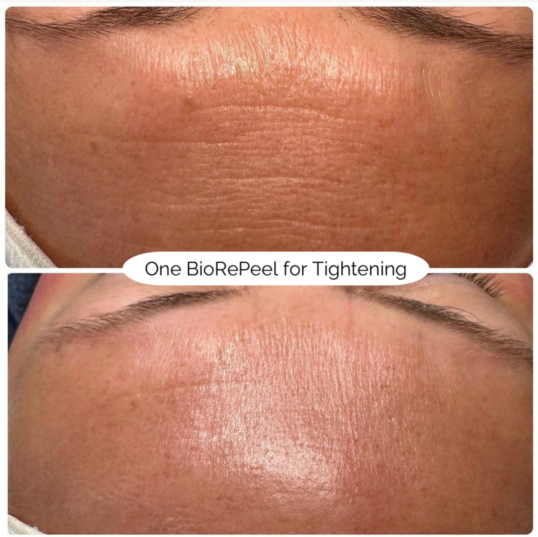 One BioRePeel for Tightening