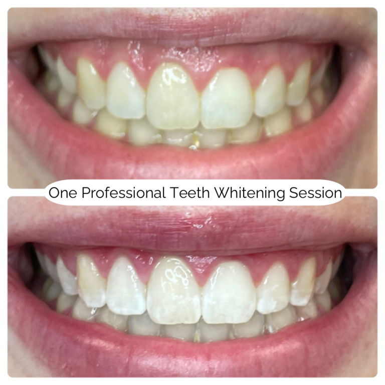 One Professional Teeth Whitening Session