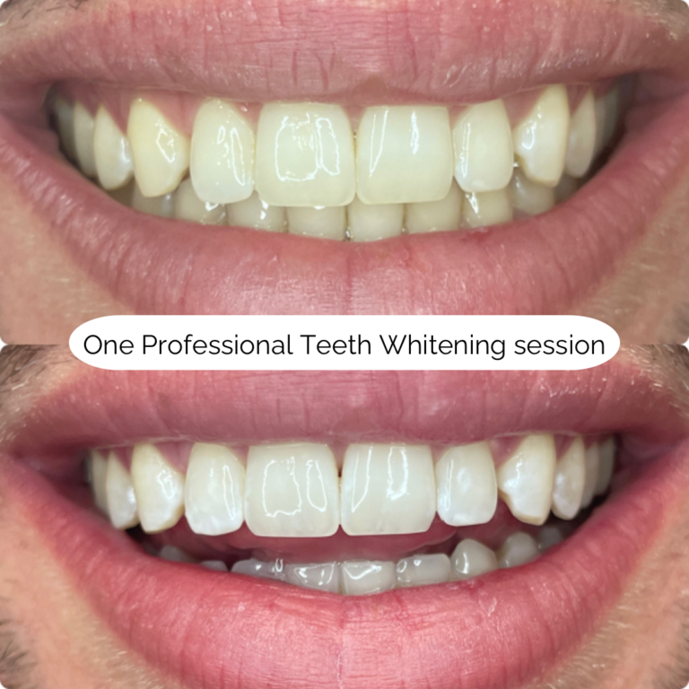 One Professional Teeth Whitening session 2