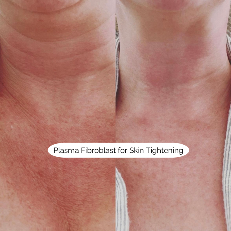 Plasma Fibroblast for Skin Tightening