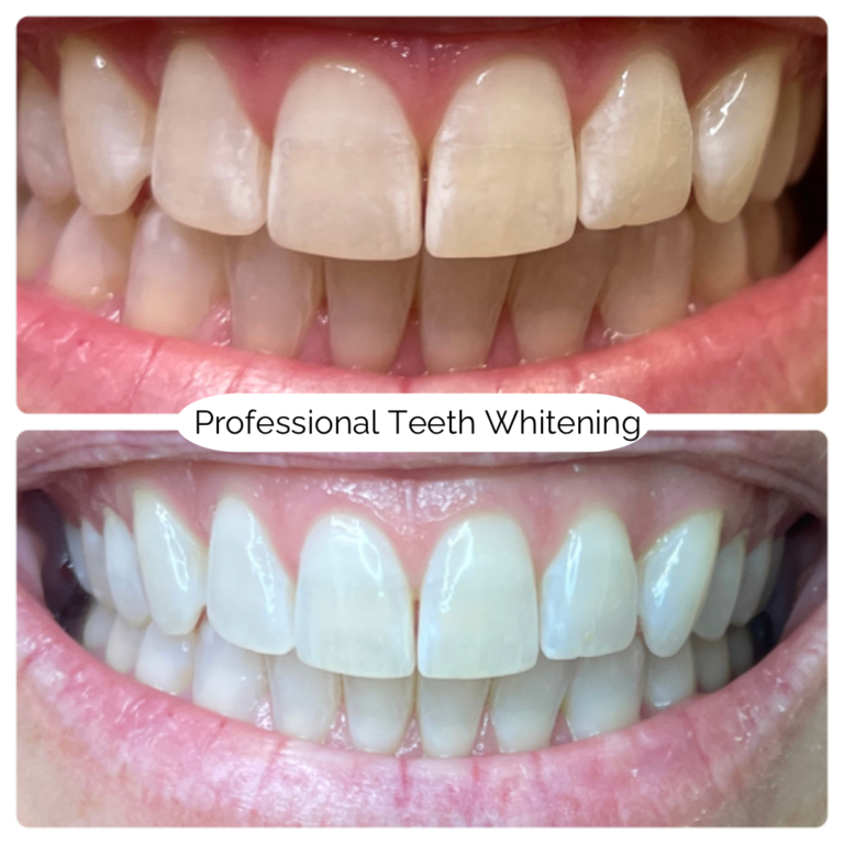 Professional Teeth Whitening 2