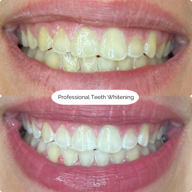 Professional Teeth Whitening