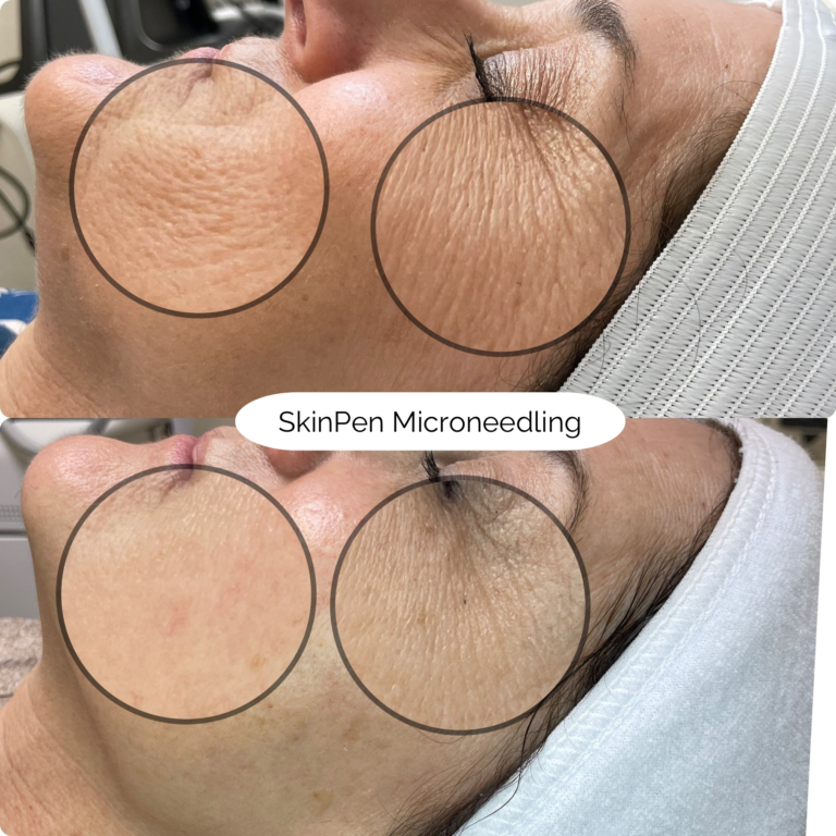 SkinPen Microneedling 2