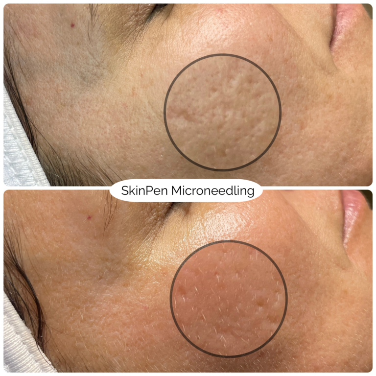 SkinPen Microneedling 3