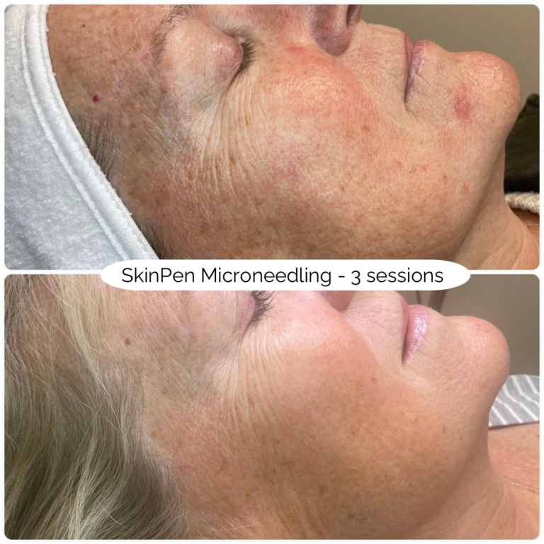 SkinPen Microneedling - 3 sessions