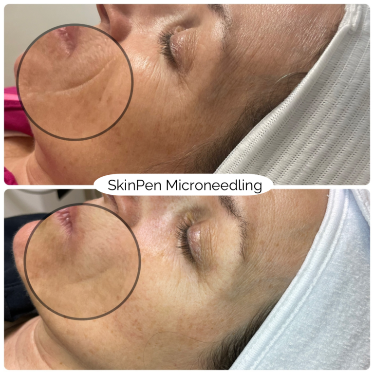 SkinPen Microneedling 4