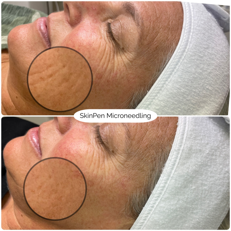 SkinPen Microneedling