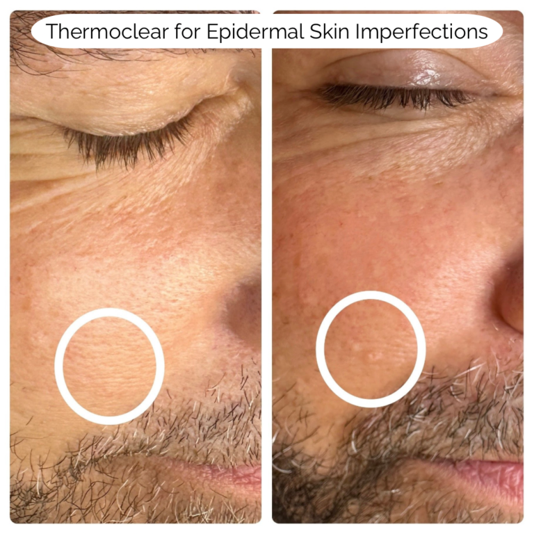 Thermoclear for Epidermal Skin Imperfections