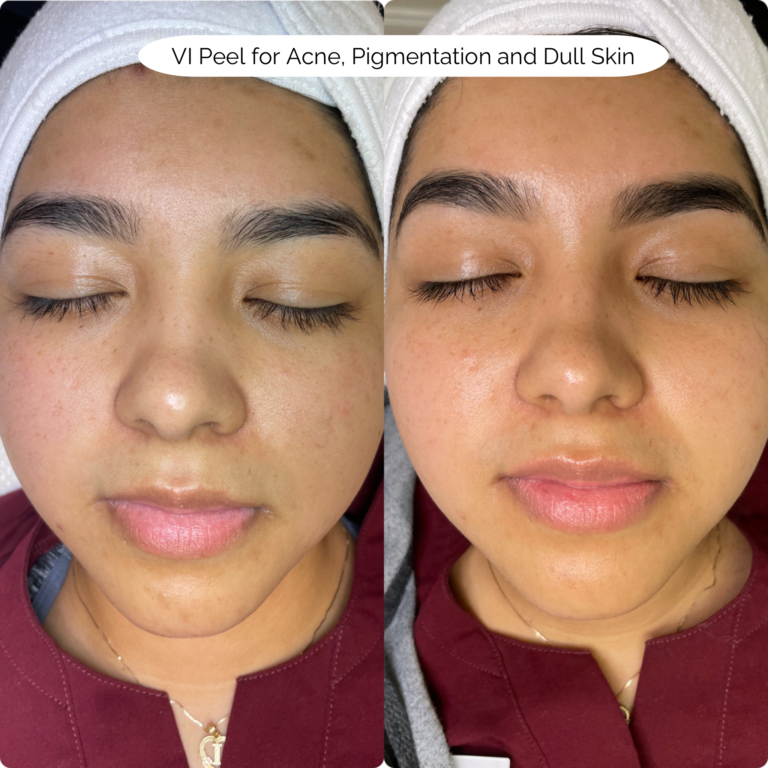 VI Peel for Acn, Pigmentation and Dull Skin