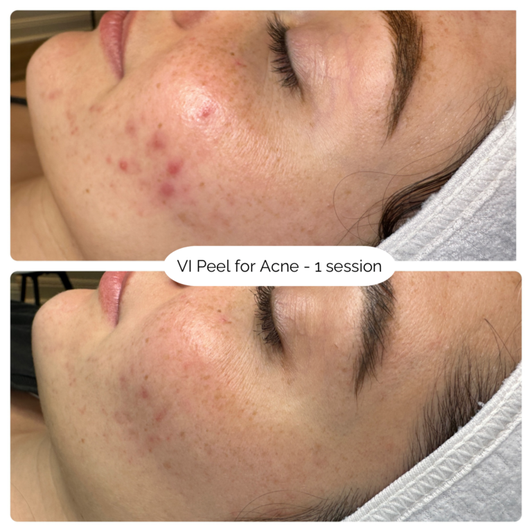 VI Peel for Acne - 1 session