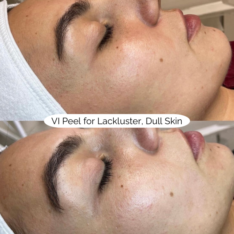 VI Peel for Lackluster, Dull Skin