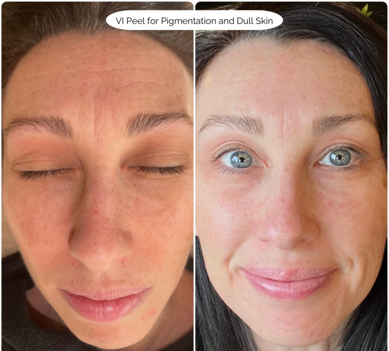 VI Peel for Pigmentation and Dull Skin