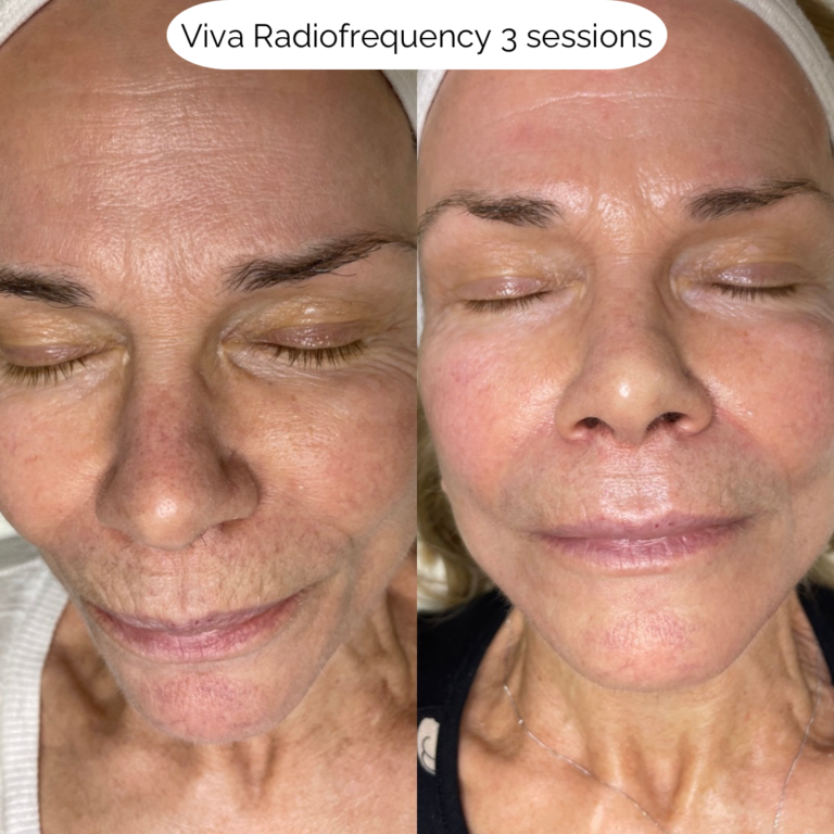 Viva Radiofrequency 3 sessions