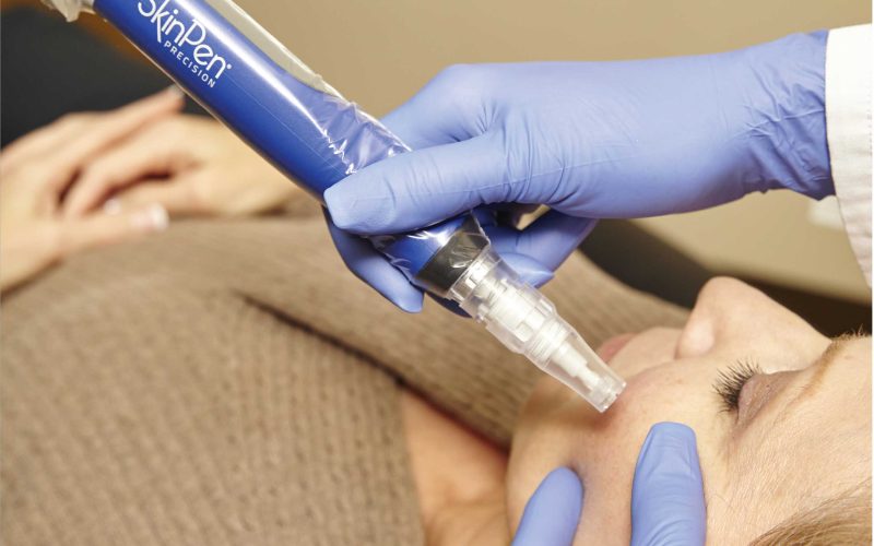 skinpen-in-action skinpen-in-action